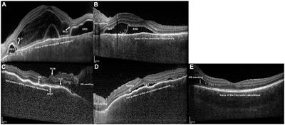 Enhanced depth imaging optical coherence tomography features of two types of Vogt–Koyanagi–Harada disease: fuzzy or lost pattern of the choroidal vasculature is of diagnostic value